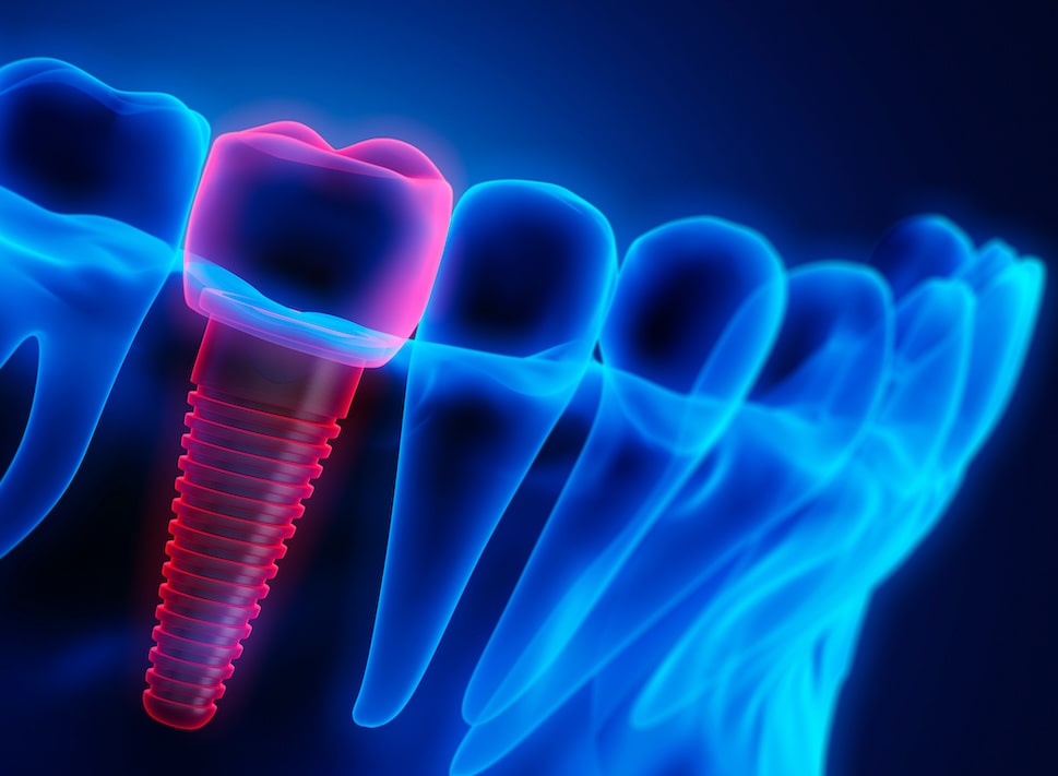 How Can Dental Implants Restore Your Natural Smile Lewes DE The